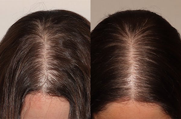 Hair Transplant Before & After Gallery - Patient 283708 - Image 1