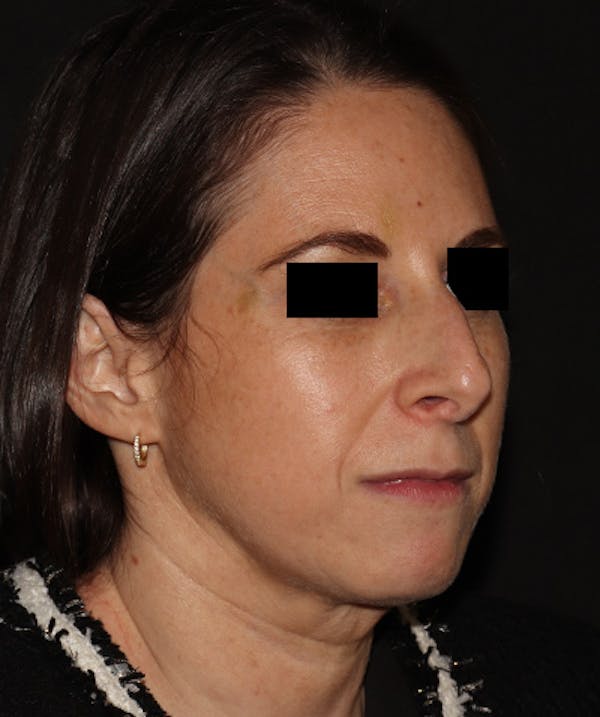 Rhinoplasty Before & After Gallery - Patient 245831 - Image 3
