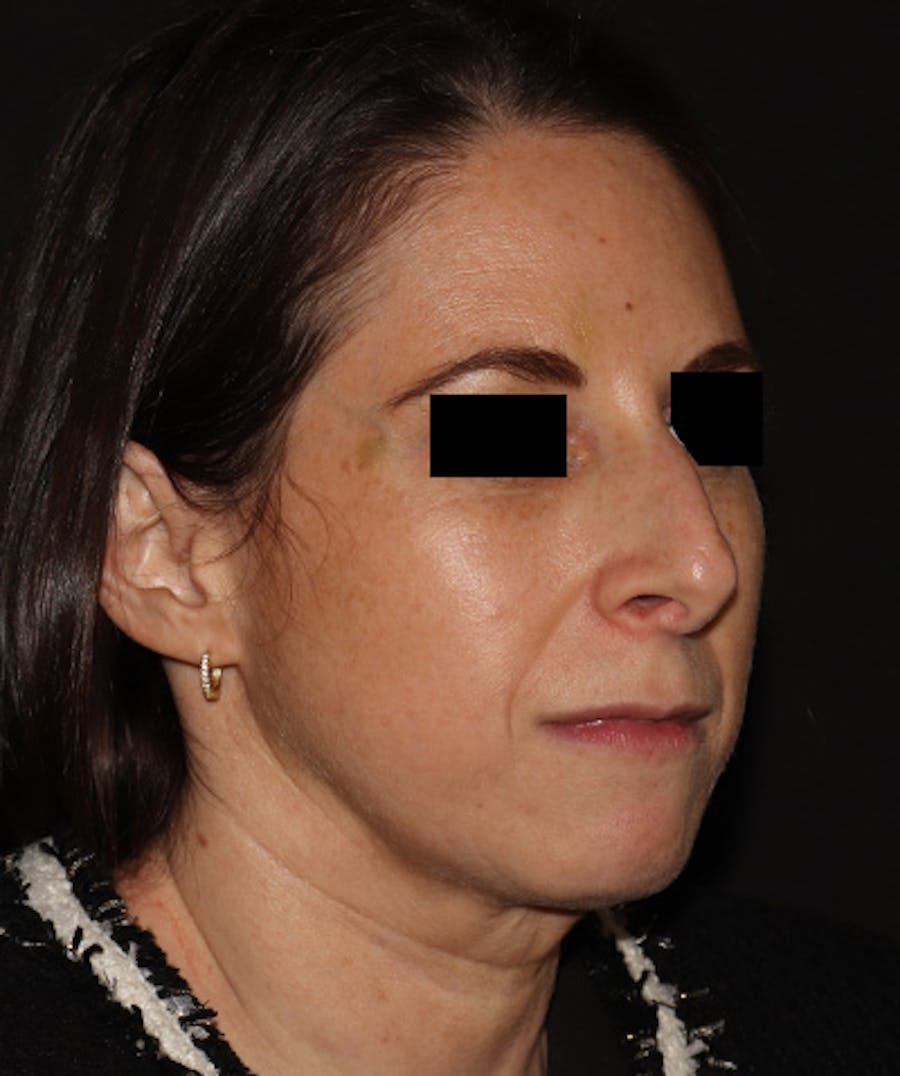 Rhinoplasty Before & After Gallery - Patient 245831 - Image 3