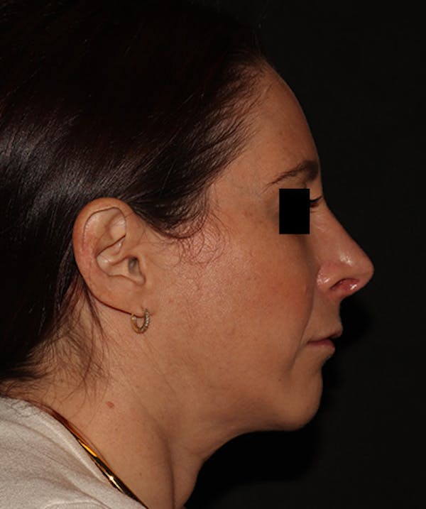 Rhinoplasty Before & After Gallery - Patient 245831 - Image 2