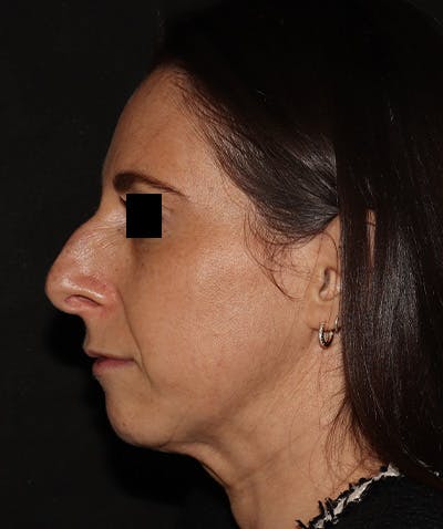 Chin Augmentation Before & After Gallery - Patient 292521 - Image 1