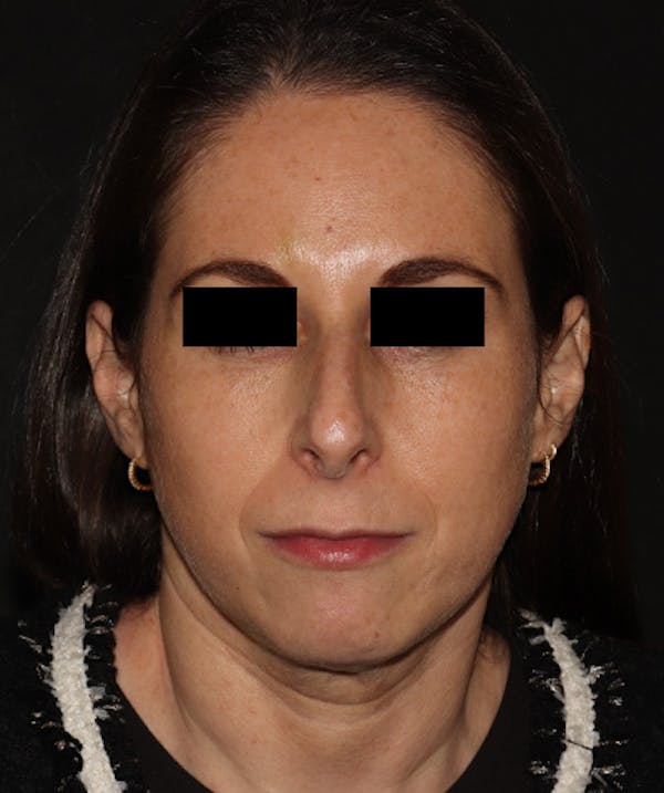 Rhinoplasty Before & After Gallery - Patient 245831 - Image 5