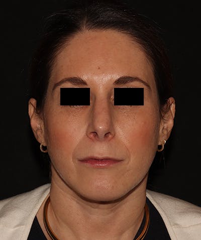 Chin Augmentation Before & After Gallery - Patient 292521 - Image 6