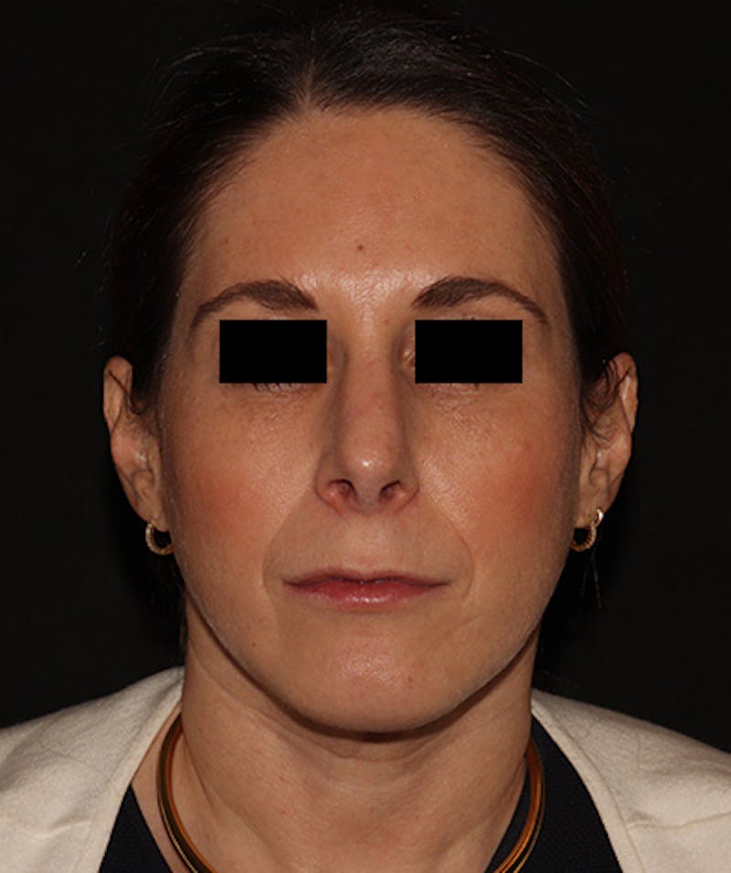 Rhinoplasty Before & After Gallery - Patient 245831 - Image 6