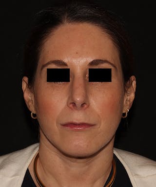 Chin Augmentation Before & After Gallery - Patient 292521 - Image 6