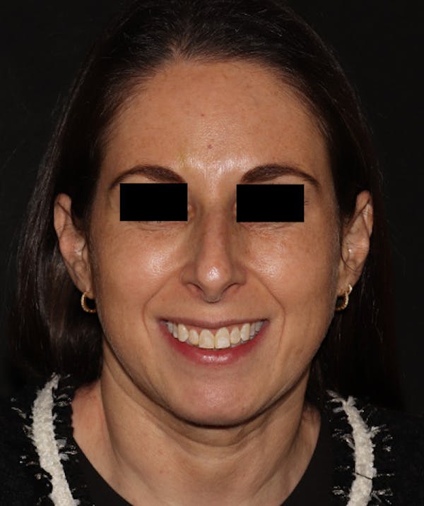 Rhinoplasty Before & After Gallery - Patient 245831 - Image 7