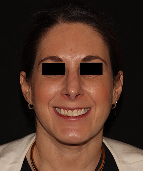 Rhinoplasty Before & After Gallery - Patient 245831 - Image 8