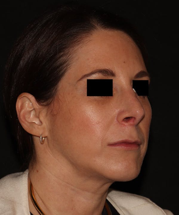 Rhinoplasty Before & After Gallery - Patient 245831 - Image 4