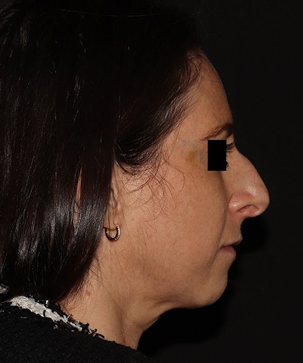 Rhinoplasty Before & After Gallery - Patient 245831 - Image 1