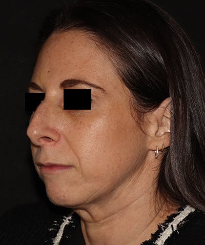 Chin Augmentation Before & After Gallery - Patient 292521 - Image 3