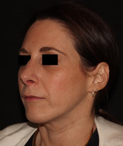 Chin Augmentation Before & After Gallery - Patient 292521 - Image 4