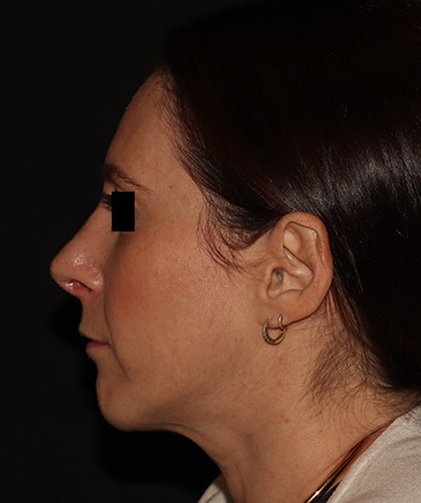 Rhinoplasty Before & After Gallery - Patient 245831 - Image 12