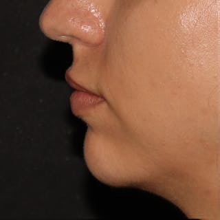 Chin Filler Before & After Gallery - Patient 141186476 - Image 4