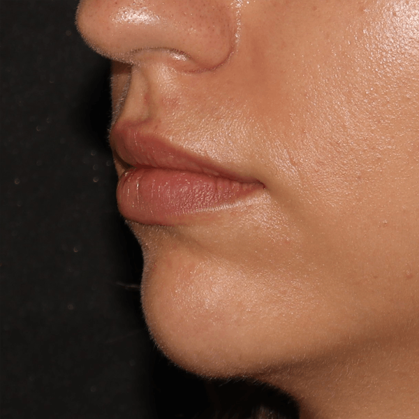 Chin Filler Before & After Gallery - Patient 141186476 - Image 1