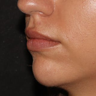 Chin Filler Before & After Gallery - Patient 141186476 - Image 2