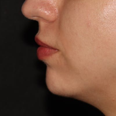 Chin Filler Before & After Gallery - Patient 141186476 - Image 4