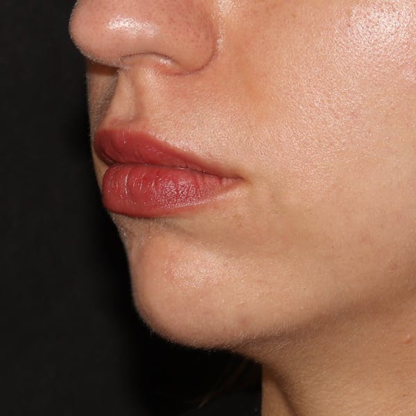Chin Filler Before & After Gallery - Patient 141186476 - Image 2