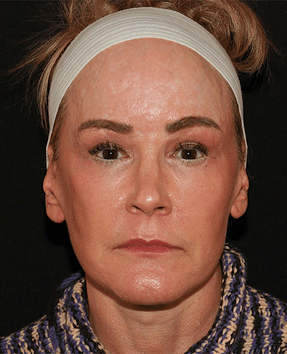 Facelift Before & After Gallery - Patient 101410085 - Image 2