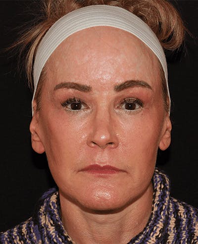 Facelift Before & After Gallery - Patient 101410085 - Image 2