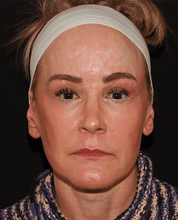 Facelift Before & After Gallery - Patient 101410085 - Image 2