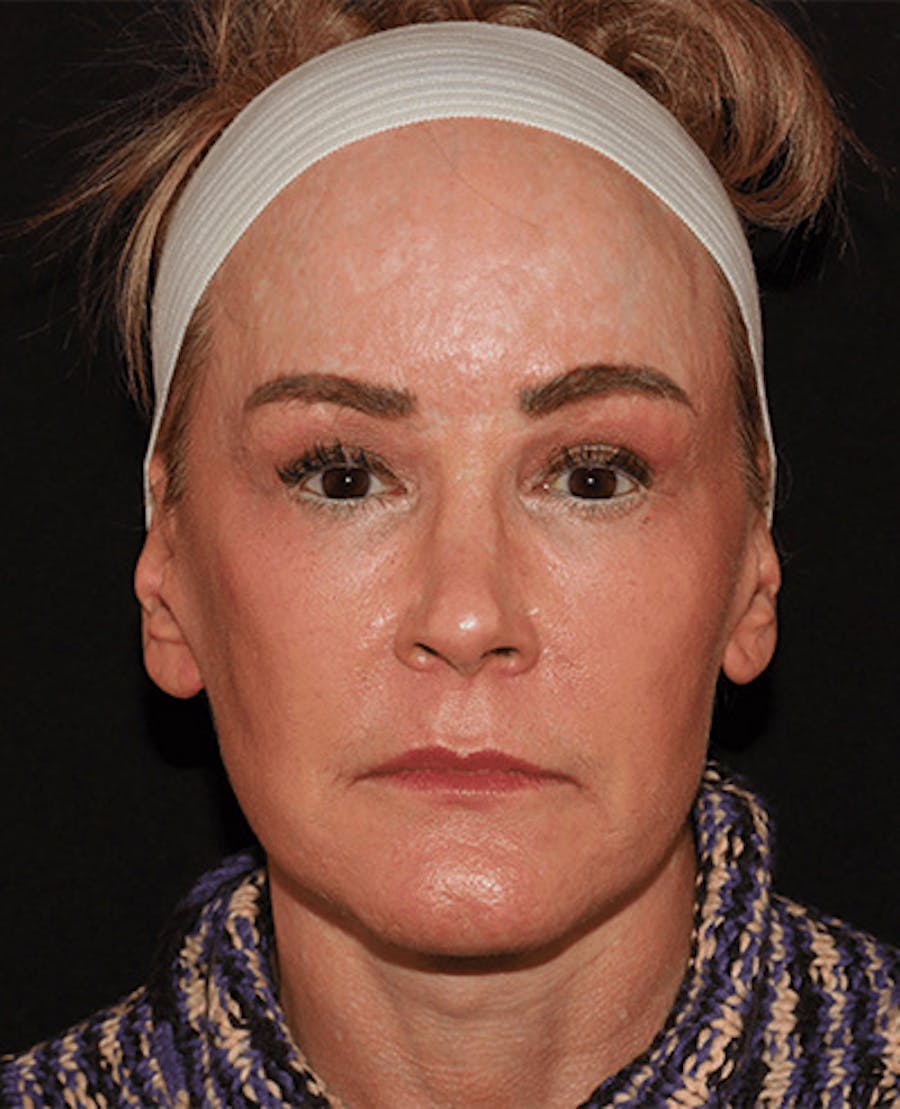 Facelift Before & After Gallery - Patient 101410085 - Image 2