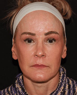 Facelift Before & After Gallery - Patient 101410085 - Image 2