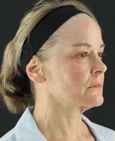 Facelift Before & After Gallery - Patient 101410085 - Image 3