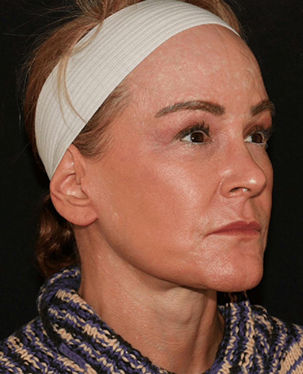Facelift Before & After Gallery - Patient 101410085 - Image 4
