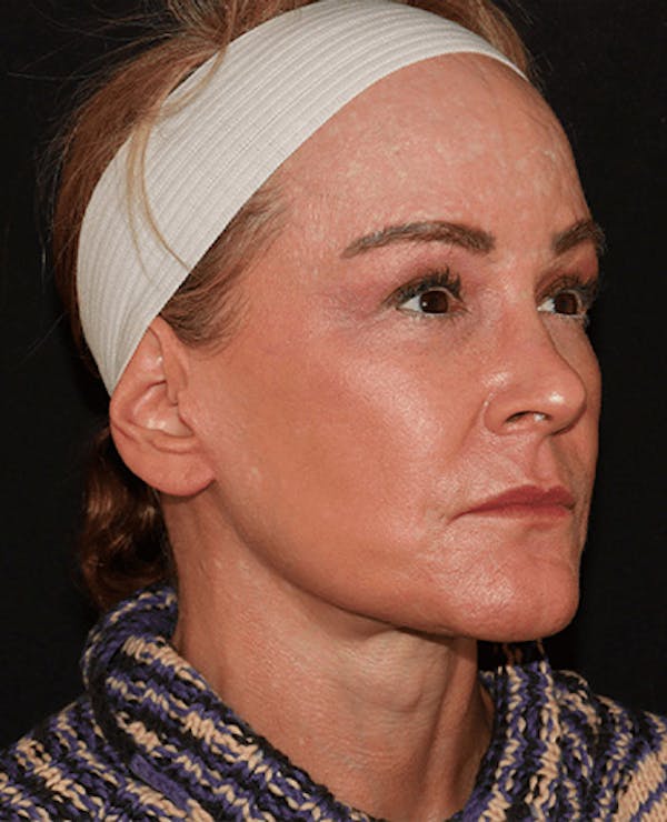 Facelift Before & After Gallery - Patient 101410085 - Image 4