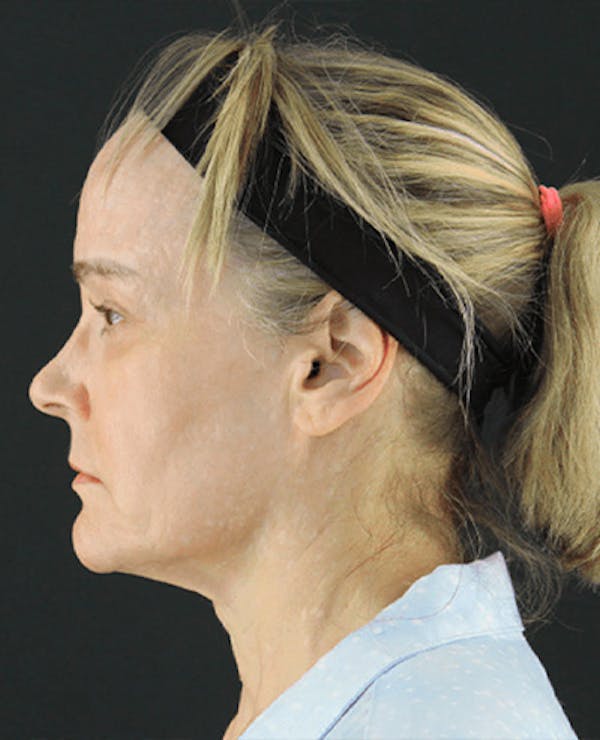 Facelift Before & After Gallery - Patient 101410085 - Image 5