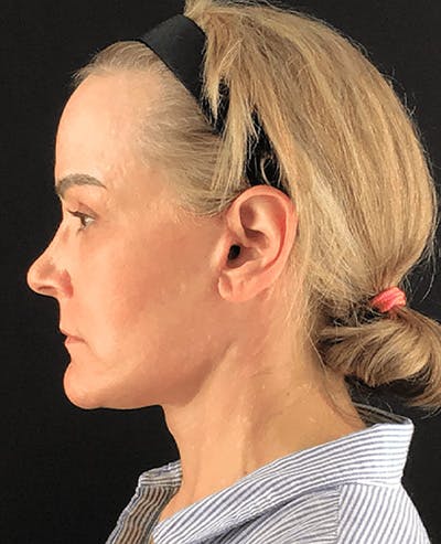 Facelift Before & After Gallery - Patient 101410085 - Image 6