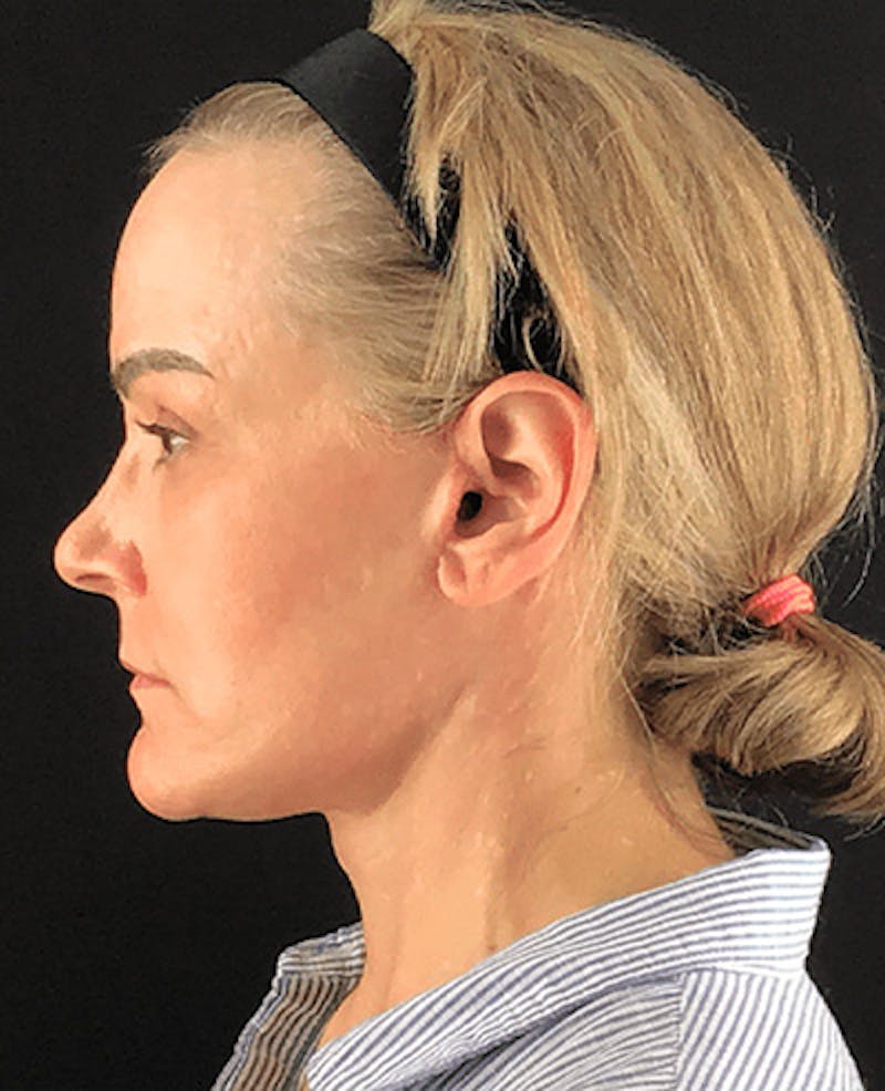 Facelift Before & After Gallery - Patient 101410085 - Image 6