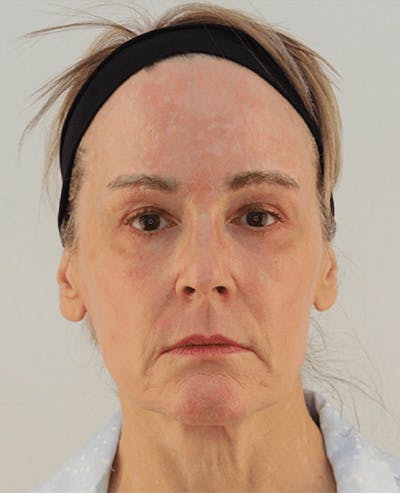 Facelift Before & After Gallery - Patient 101410085 - Image 1