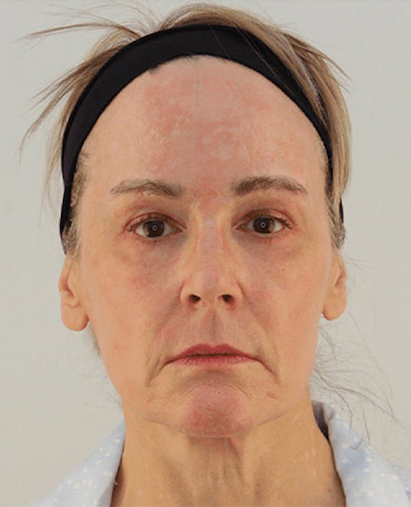Facelift Before & After Gallery - Patient 101410085 - Image 1