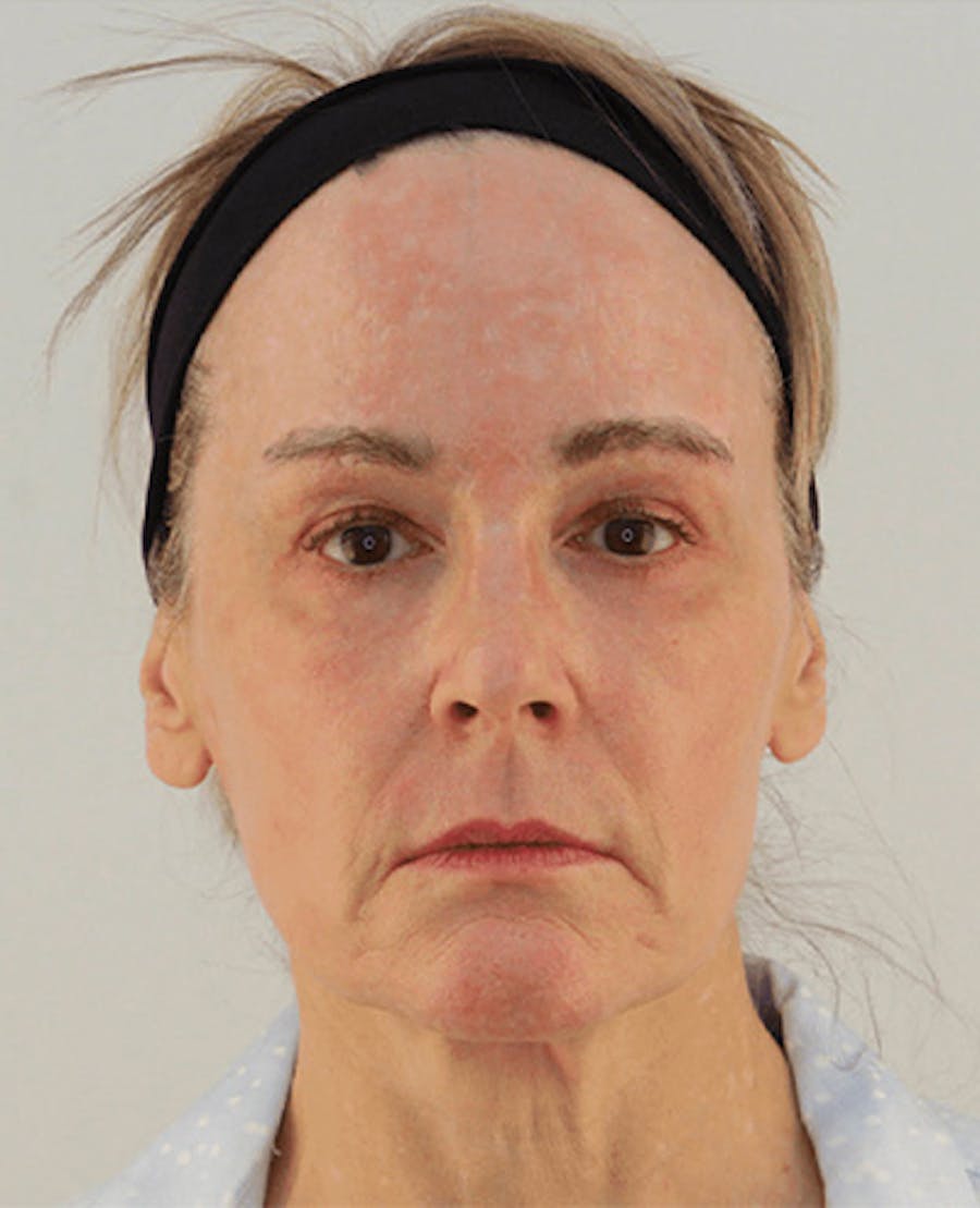Facelift Before & After Gallery - Patient 101410085 - Image 1