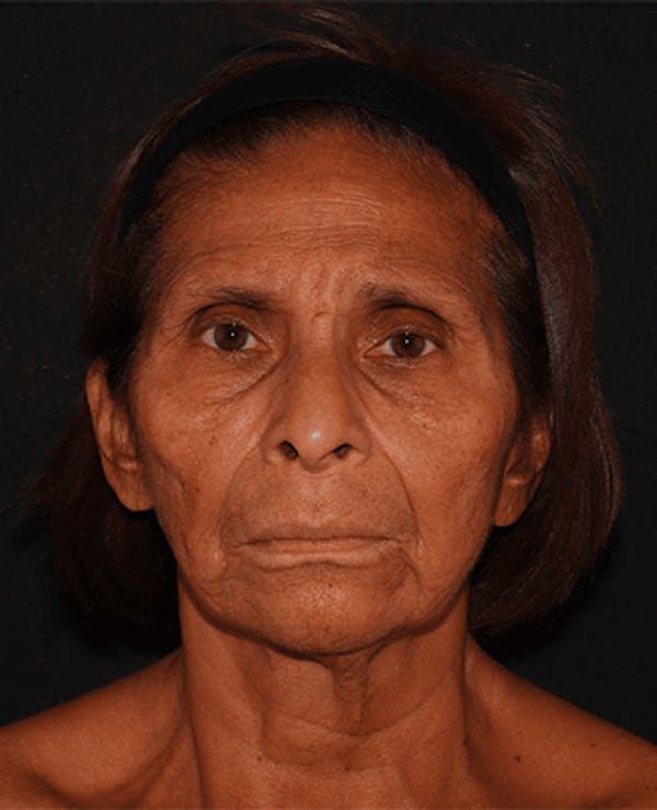 Facelift Before & After Gallery - Patient 101409974 - Image 1