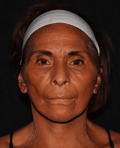 Facelift Before & After Gallery - Patient 101409974 - Image 2