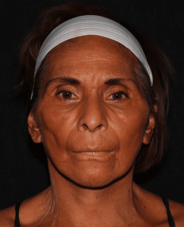 Facelift Before & After Gallery - Patient 101409974 - Image 2