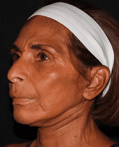 Facelift Before & After Gallery - Patient 101409974 - Image 4
