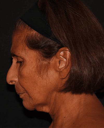 Facelift Before & After Gallery - Patient 101409974 - Image 5