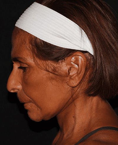 Facelift Before & After Gallery - Patient 101409974 - Image 6