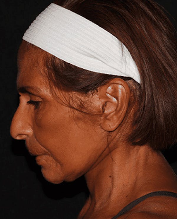 Facelift Before & After Gallery - Patient 101409974 - Image 6