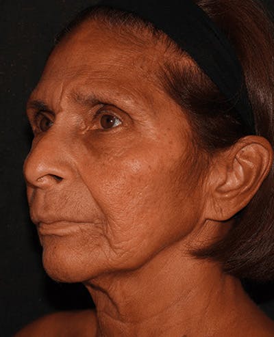 Facelift Before & After Gallery - Patient 101409974 - Image 3