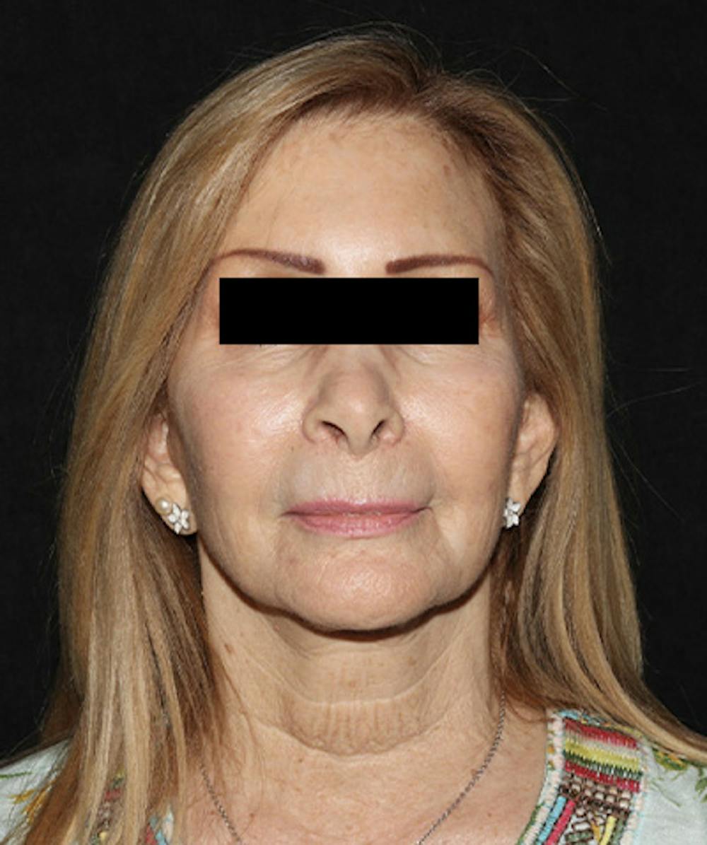 Facelift Before & After Gallery - Patient 121258980 - Image 1
