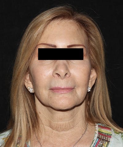 Facelift Before & After Gallery - Patient 121258980 - Image 1
