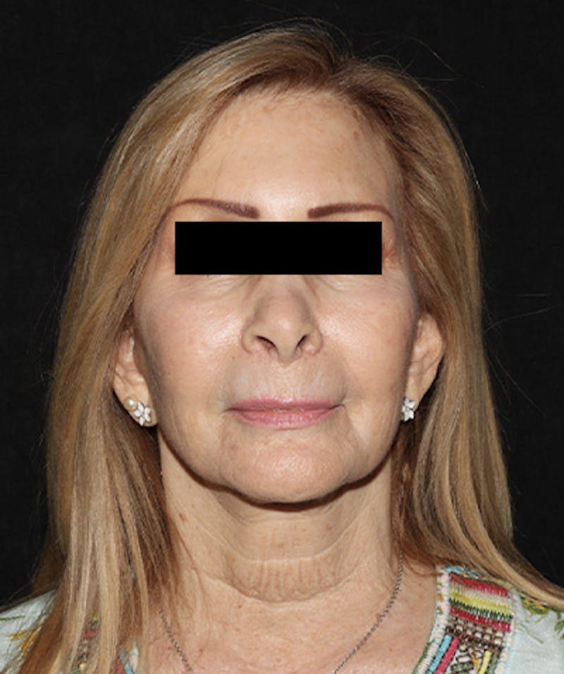 Facelift Before & After Gallery - Patient 121258980 - Image 1