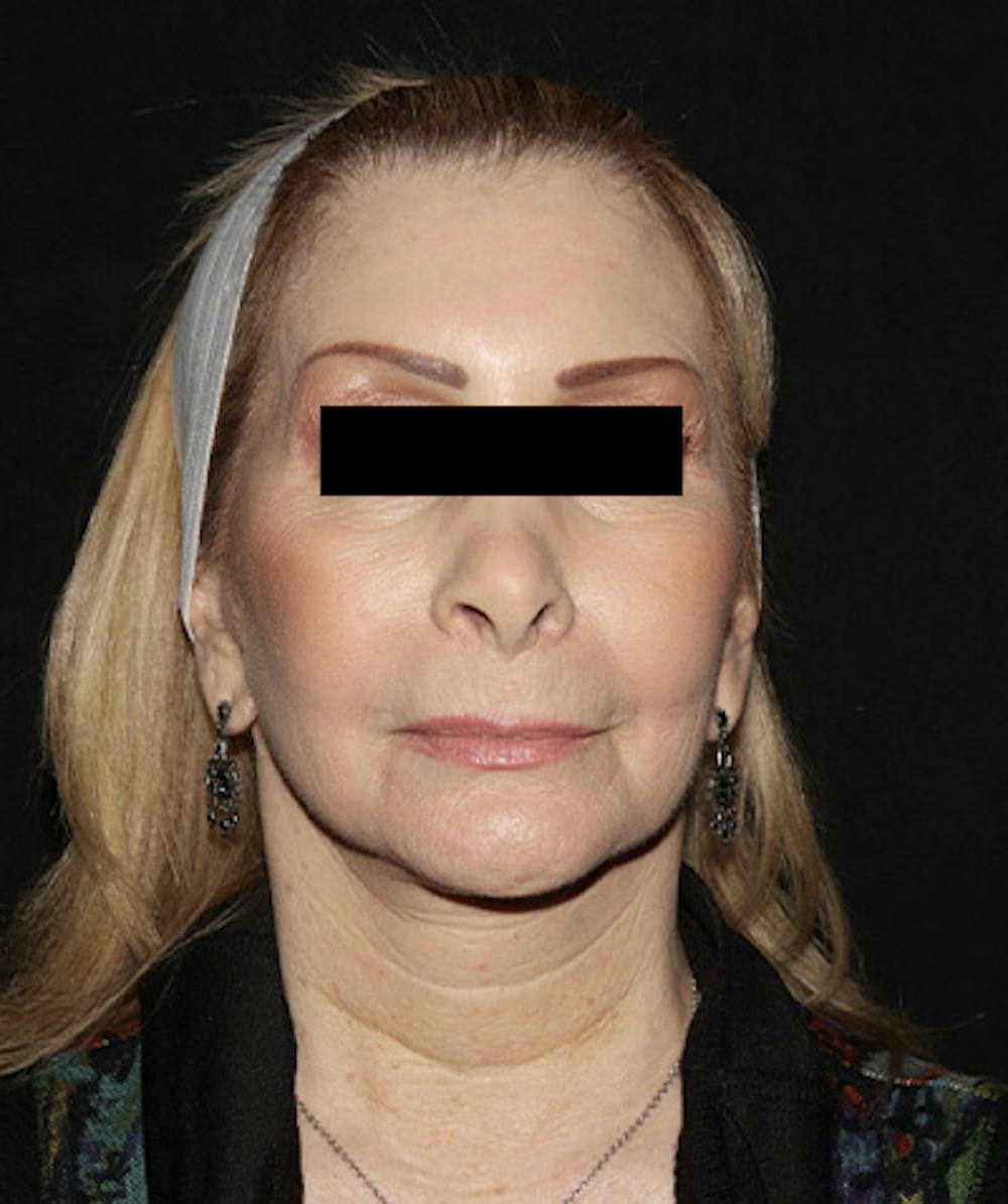 Facelift Before & After Gallery - Patient 121258980 - Image 2