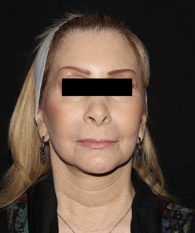 Facelift Before & After Gallery - Patient 121258980 - Image 2