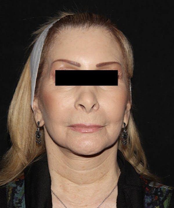 Facelift Before & After Gallery - Patient 121258980 - Image 2