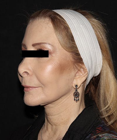 Facelift Before & After Gallery - Patient 121258980 - Image 4